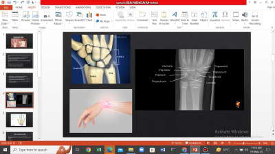 Normal and Radiological anatomy of carpal bones