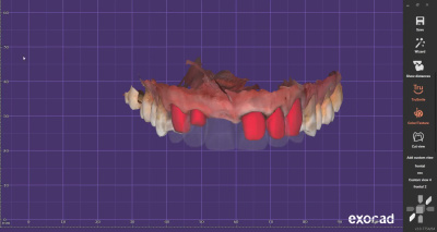 High-Precision Dental CAD/CAM Designs | Crowns, Bridges, Veneers & More ...