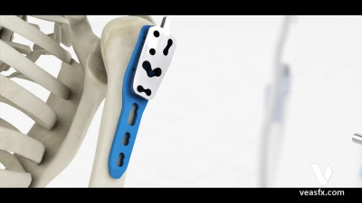 Medical device animation, medical device rendering, surgical animation