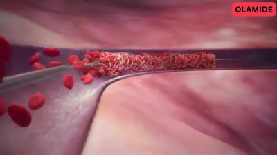 3d medical animation 3d surgery animation 3d medical explainer animation