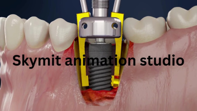 3d dental animation medical animation 3d tooth surgery animation