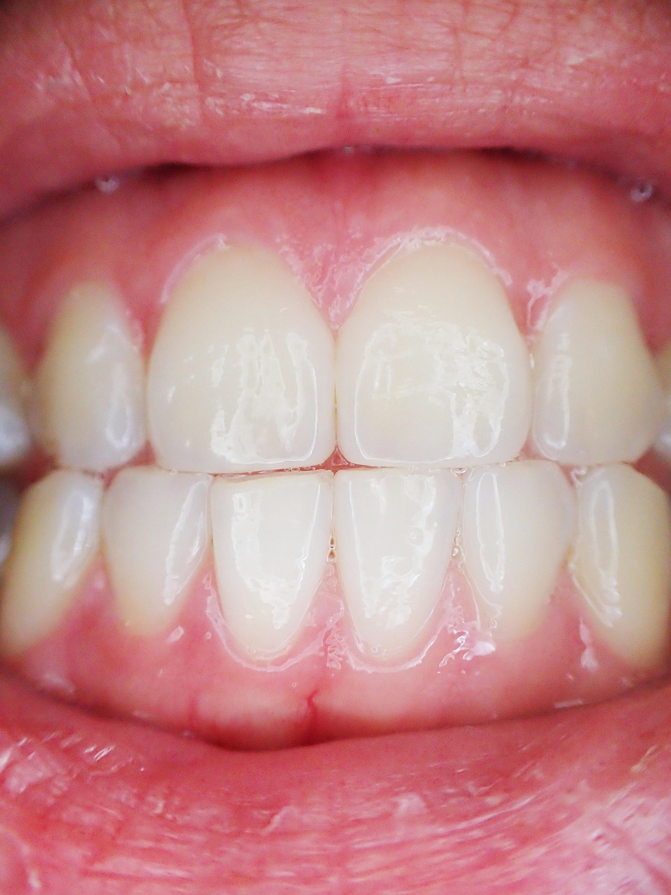 Understanding Gum Infection Through Everyday Oral Health Awareness