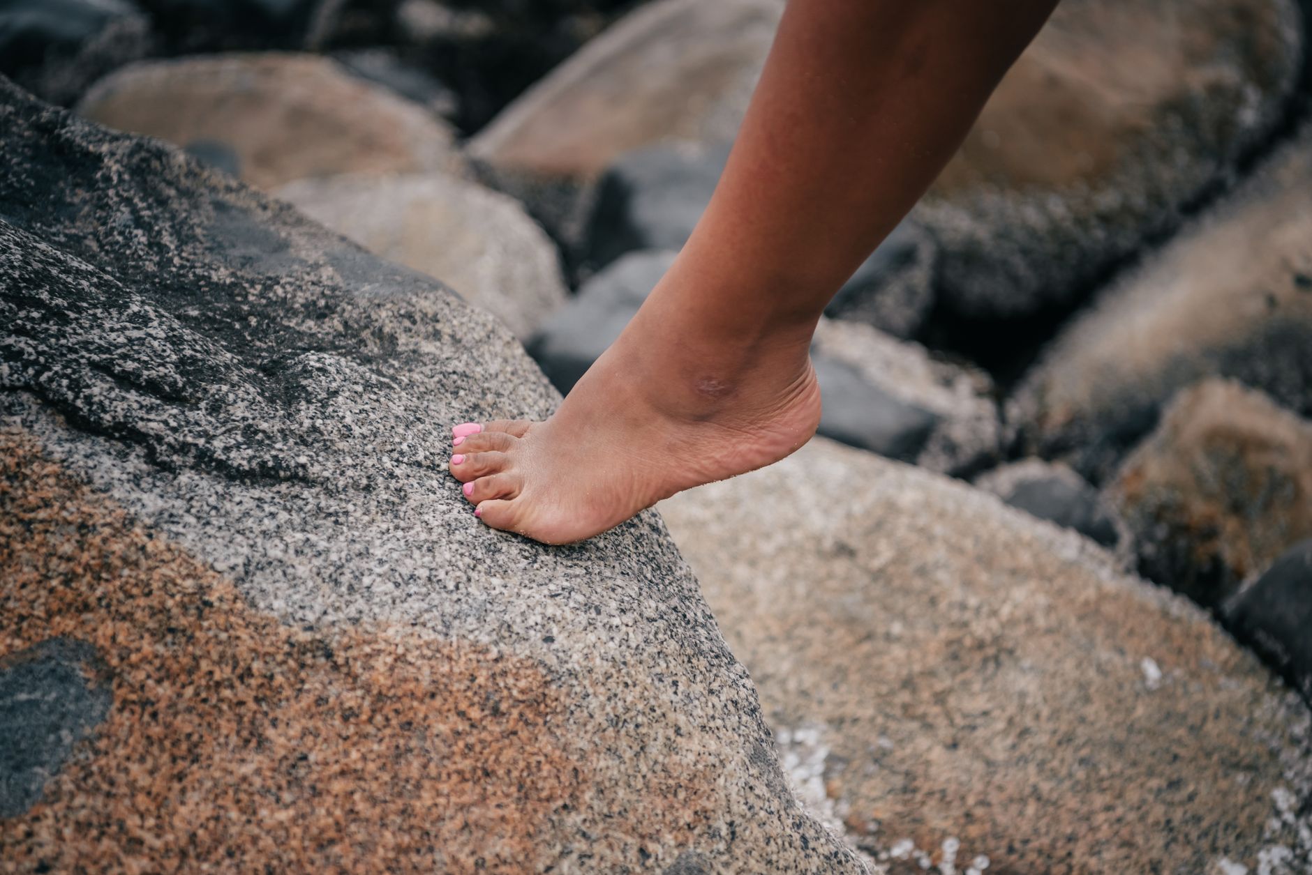 Bunions Treatment Options