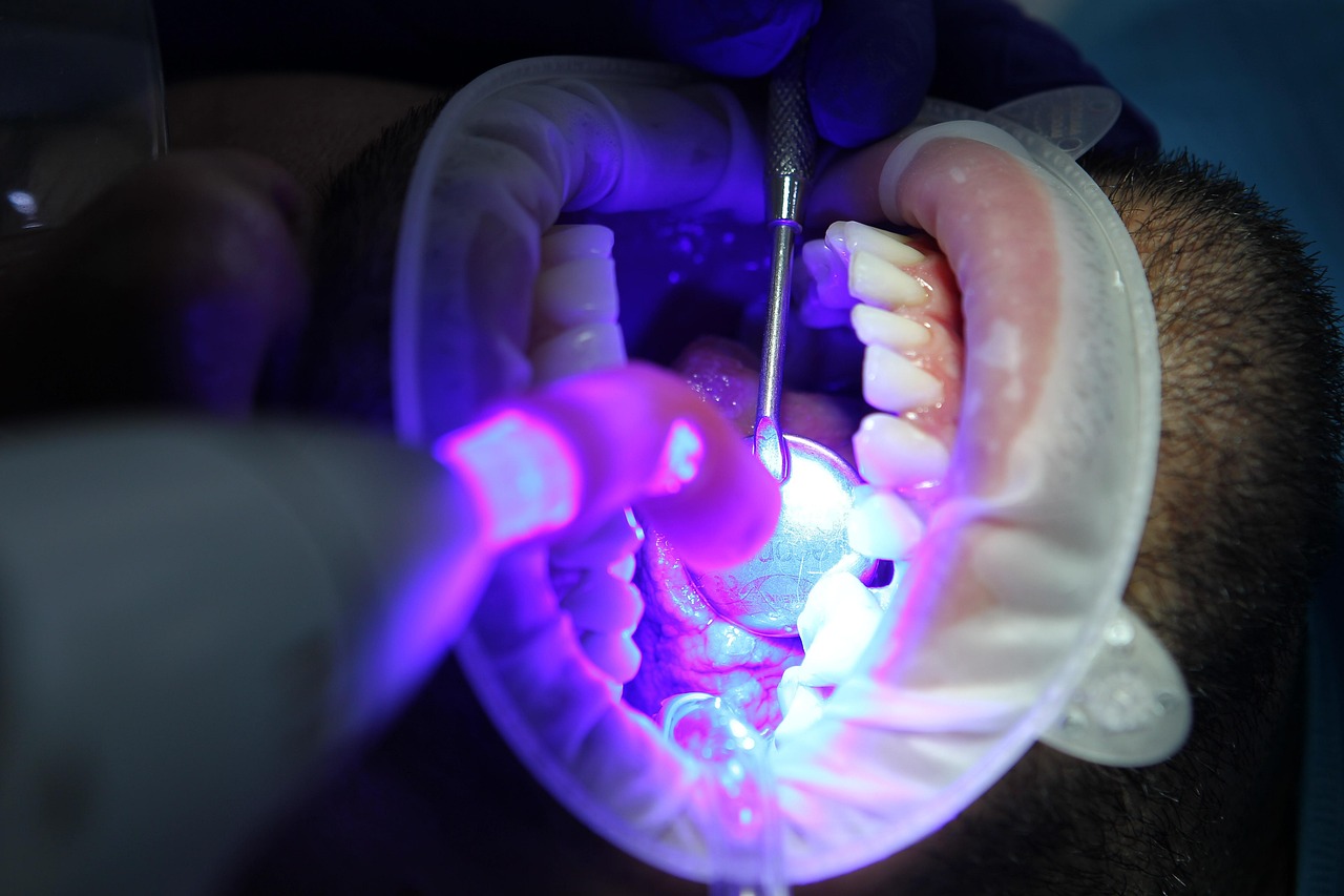 Laser Teeth Whitening-  A Brighter Smile, Naturally
