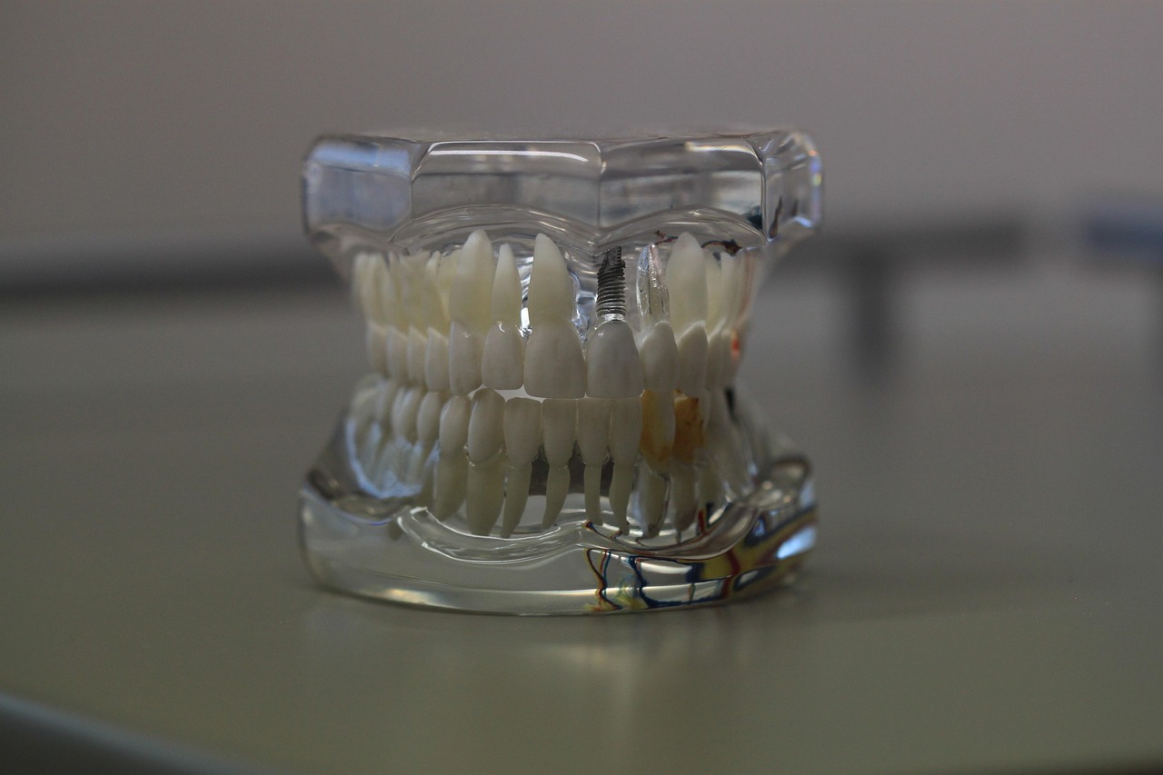 6 Tips to Take Care of Your Dental Veneers