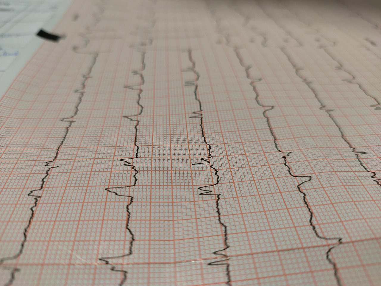 Exercise and heart health: Insights from a Cardiologist