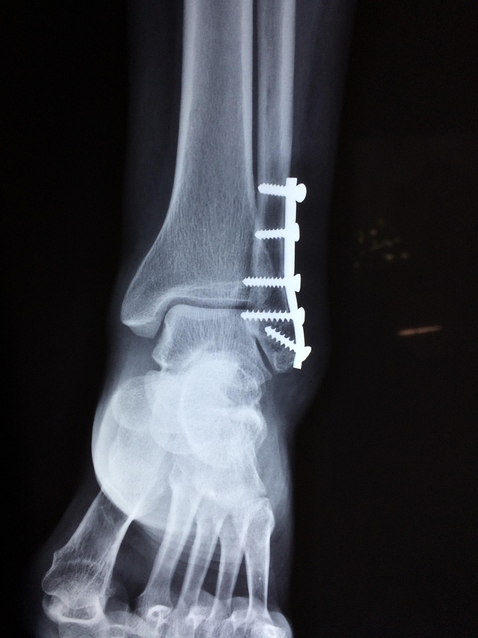 Pediatric Orthopedic Surgery: What Parents Need To Know