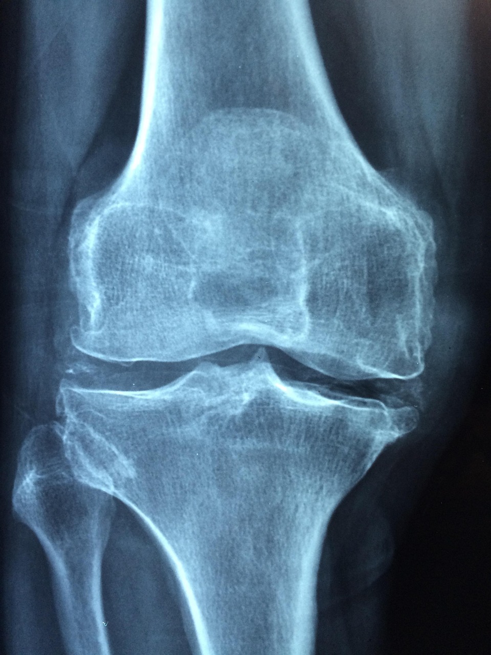 OrthoFreeze for Sports Injuries: Cooling Down Inflammation and Speeding Up Recovery