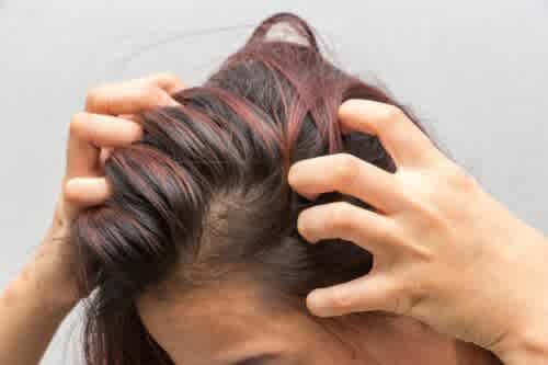 Itchy scalp greasy hair
