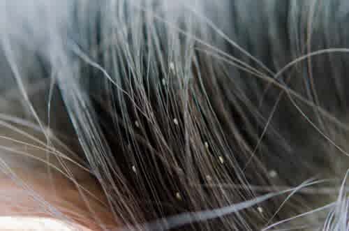 how to remove lice from hair