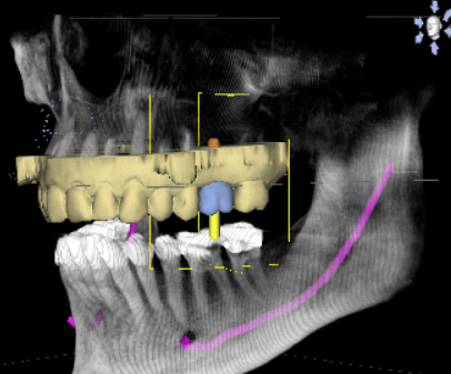 數位植牙的圖