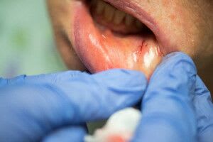 lip-salivary-gland-biopsy-4.jpg Step 4: The doctor closes the incision with an absorbable suture.