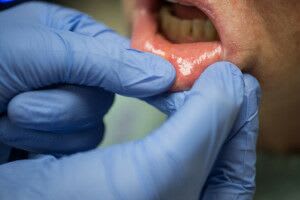 lip-salivary-gland-biopsy-1.jpg Step 1: The doctor identifies a minor salivary gland located in the lower lip.