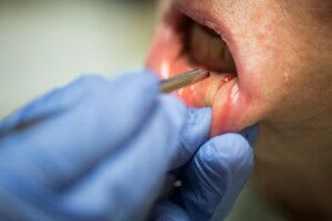 lip-salivary-gland-biopsy-3.jpg Step 3: The doctor makes a small incision, taking care to avoid damage to small nerves and blood vessels. The gland sticks out and the doctor uses forceps to remove the gland.
