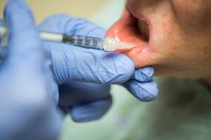 lip-salivary-gland-biopsy-2.jpg Step 2: The doctor injects a drug to numb the area of the lower lip that has the most glands.