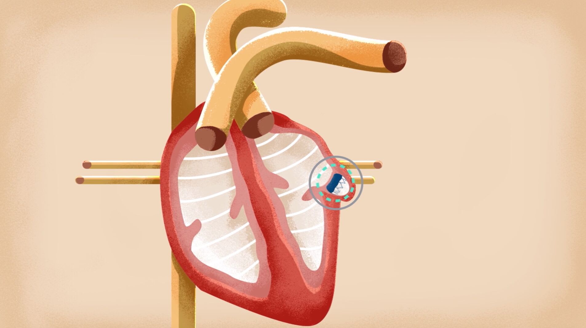 Watchman implant Treatments UW Health