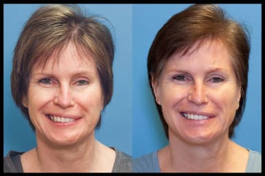 Before and after photos of a patient with facial nerve paralysis