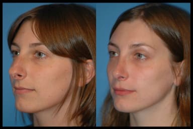 Before and after photos from a rhinoplasty