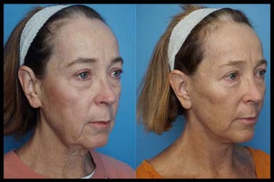 A side profile of before and after photos from a facelift procedure