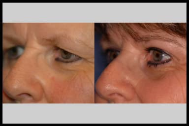 Before and after photos from a blepharoplasty procedure