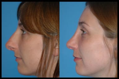 Before and after photos from a rhinoplasty