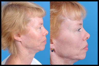 Before and after photos from a blepharoplasty procedure