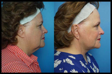 A side profile of before and after photos from a facelift procedure