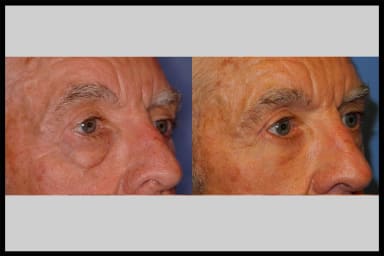 Before and after photos from a blepharoplasty procedure