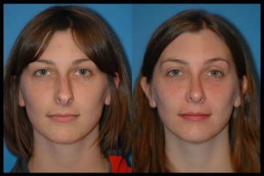 Before and after photos from a rhinoplasty