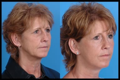 Before and after photos from a rhinoplasty