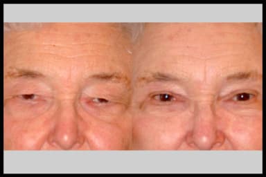 Before and after photos from a blepharoplasty procedure