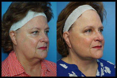 A side profile of before and after photos from a facelift procedure