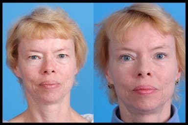 Before and after photos from a blepharoplasty procedure