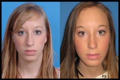 Before and after photos from a rhinoplasty