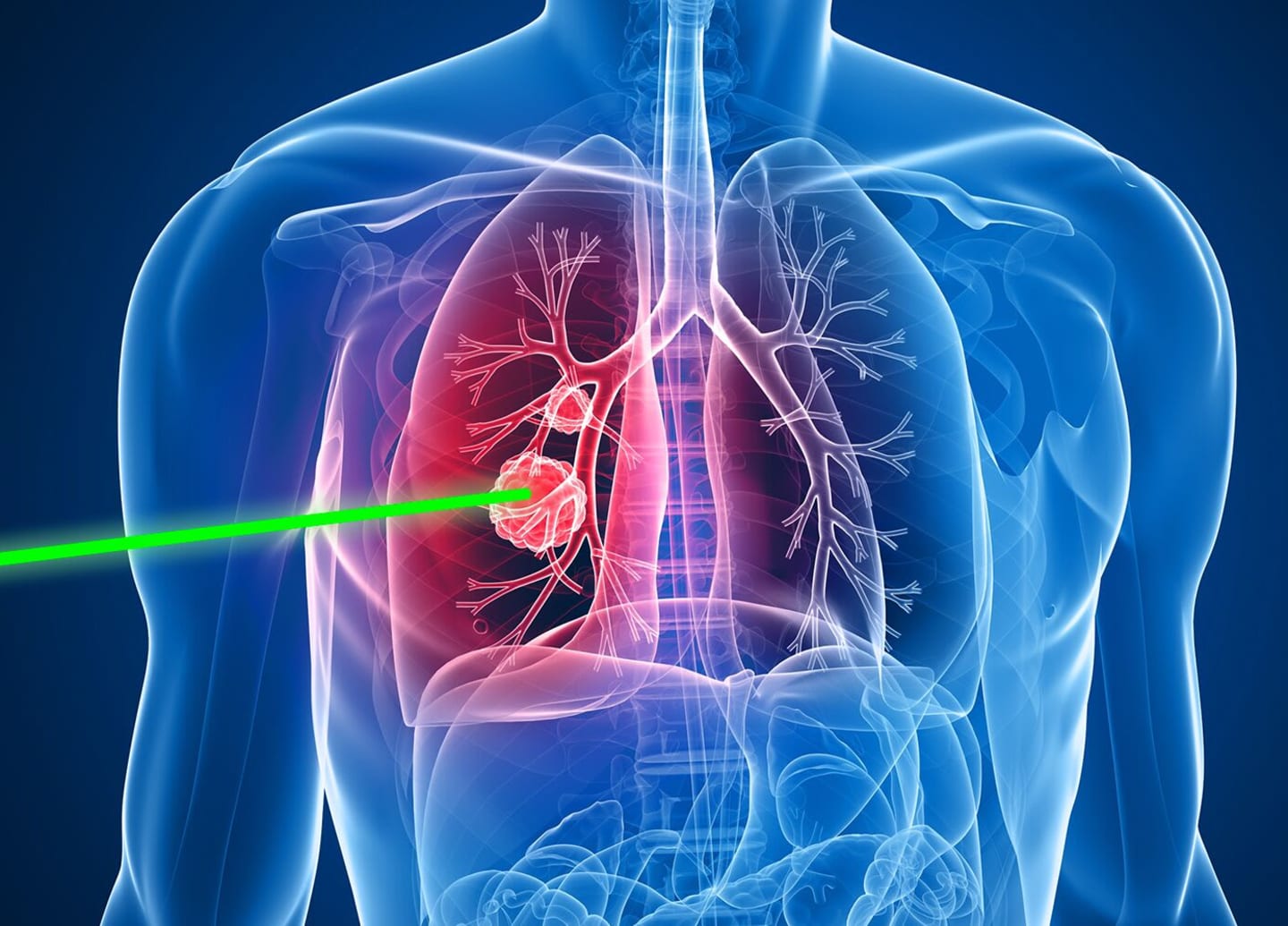 Illustration of proton therapy targeting a lung tumor