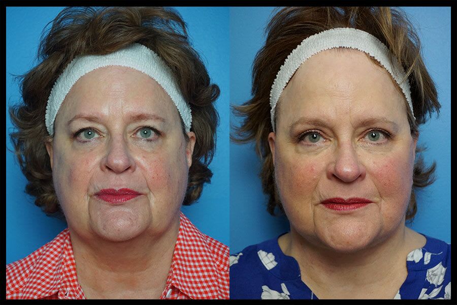 Before and after photos from a face lift surgery