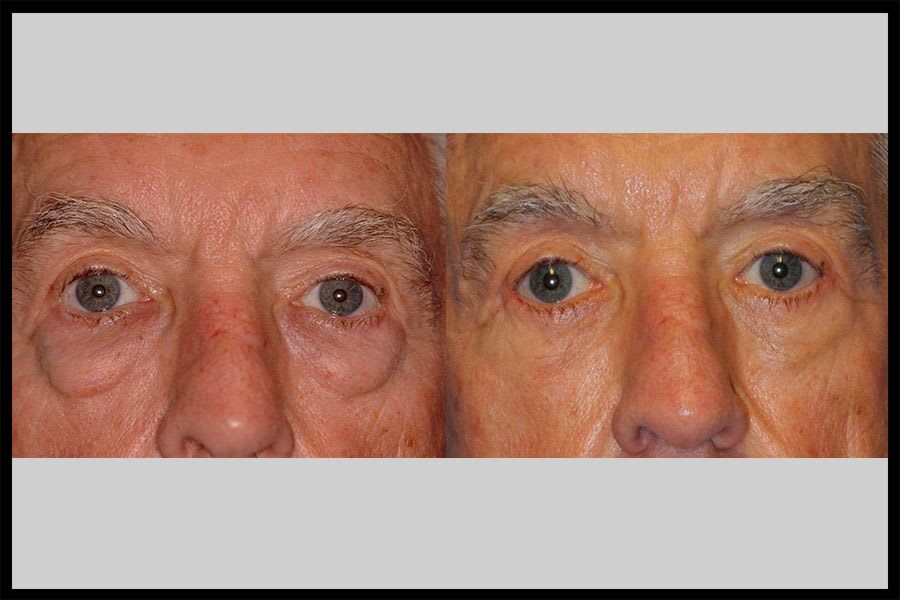 Before and after photos from a blepharoplasty procedure