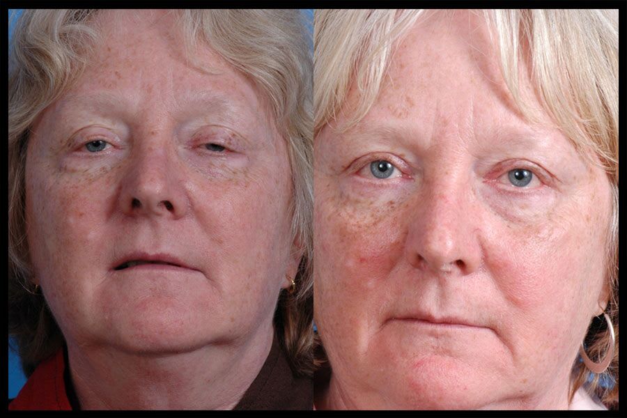 Before and after photos from a blepharoplasty procedure