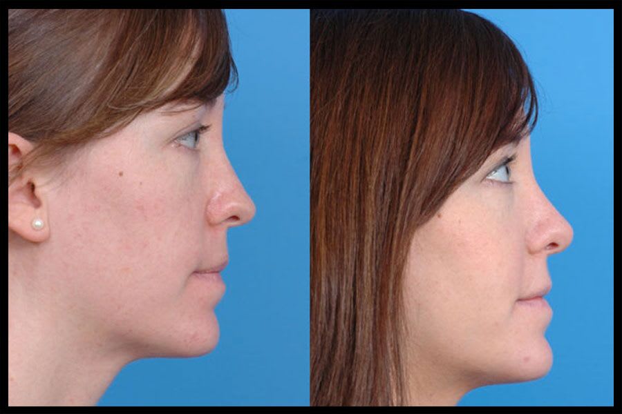 Before and after photos from a rhinoplasty