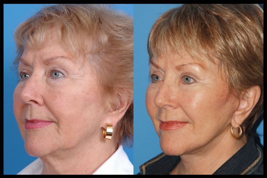 A side profile of before and after photos from a facelift procedure