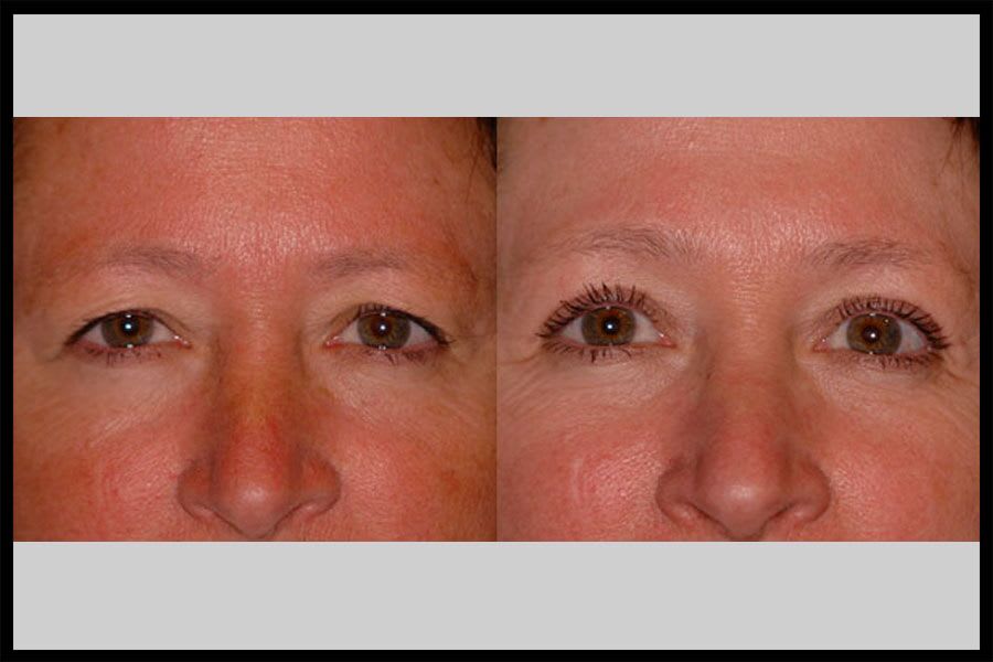 Before and after photos from a blepharoplasty procedure