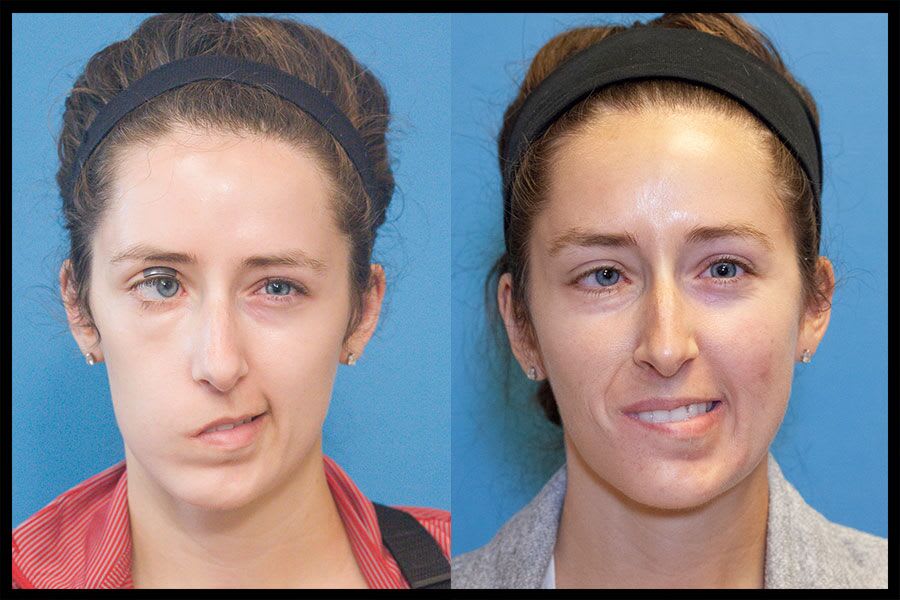 Before and after treatment photos for a facial nerve paralysis patient