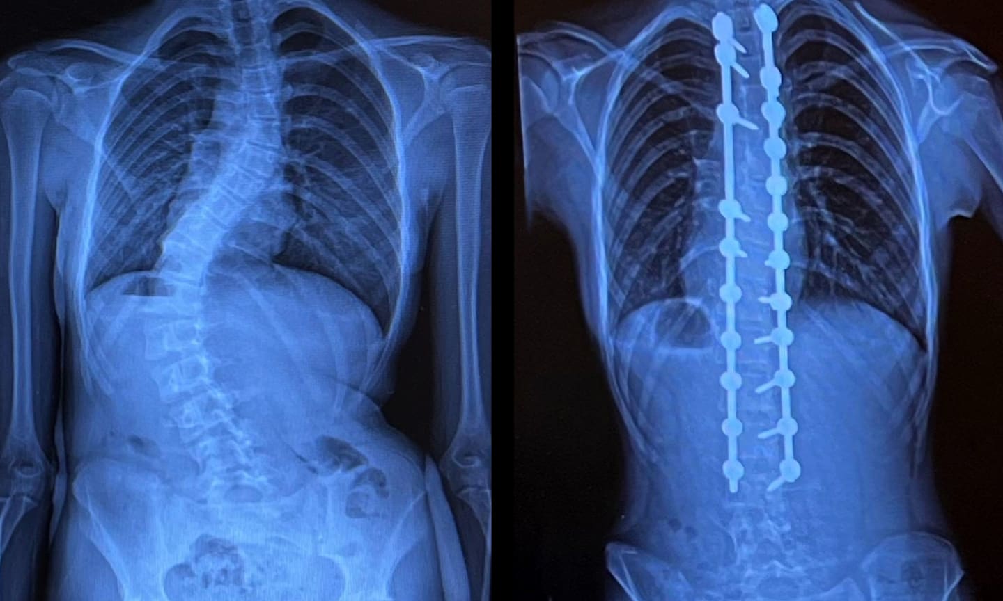 These are "before" and "after" X-rays for scoliosis patient Danielle (Dani) Olson, who had spinal fusion surgery. 