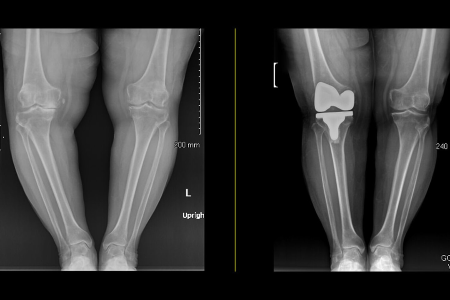 Susan Cowles X-ray - Before and after