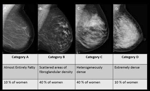 Radiology images of the four categories of dense breast tissue