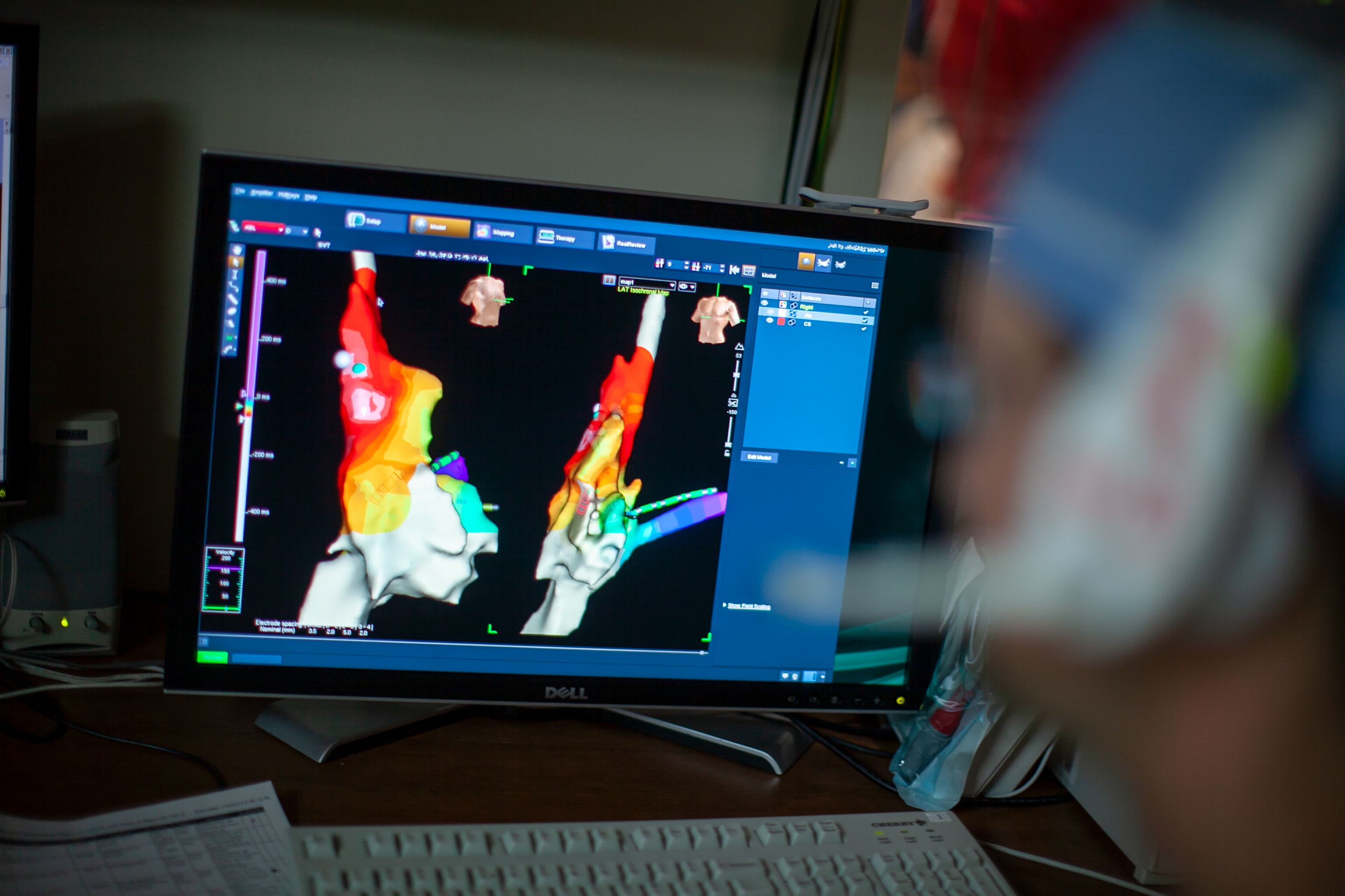 Heart Ablation Treatment UW Health Treatments UW Health