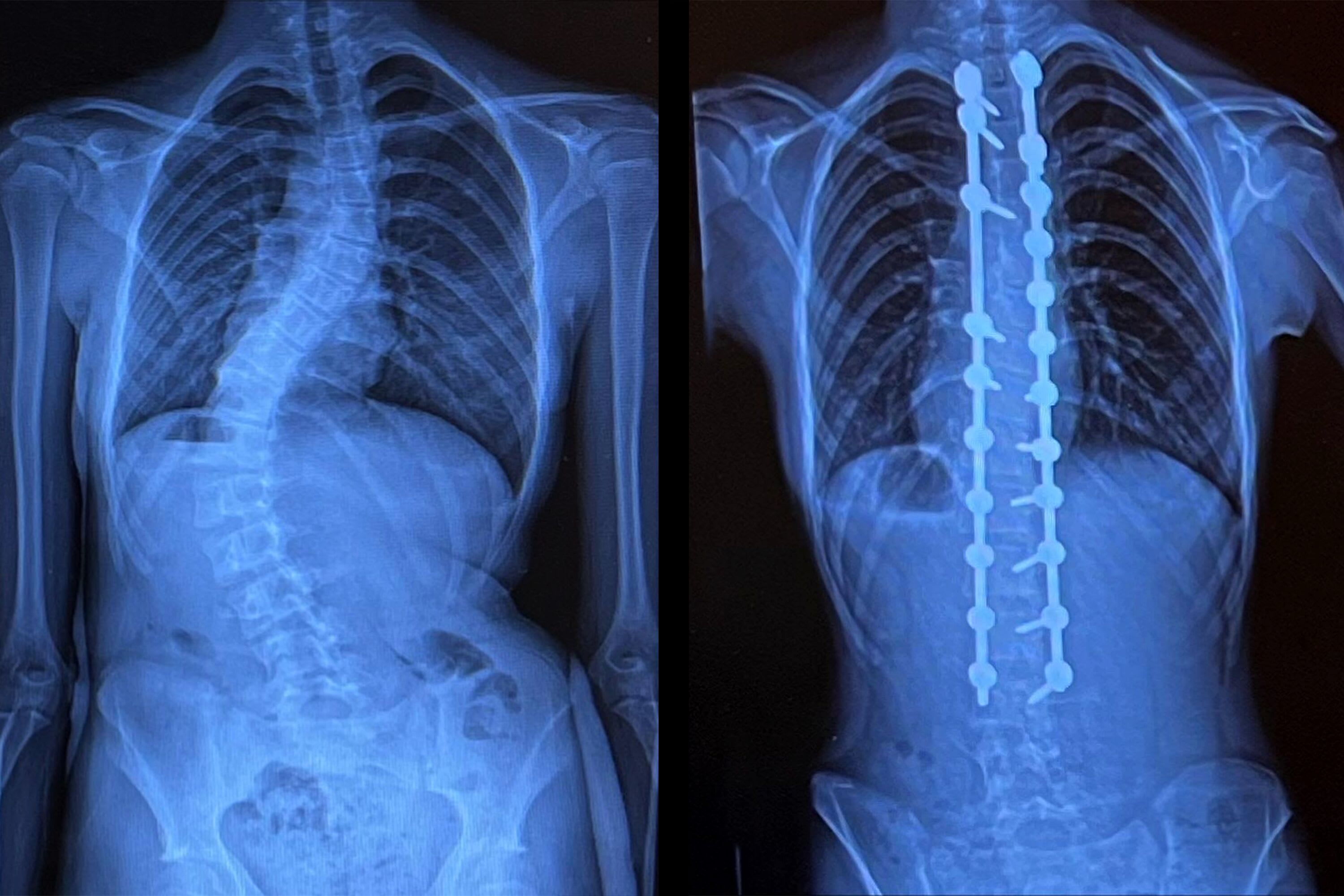 Dani’s doing great after surgery for a curved spine UW Health