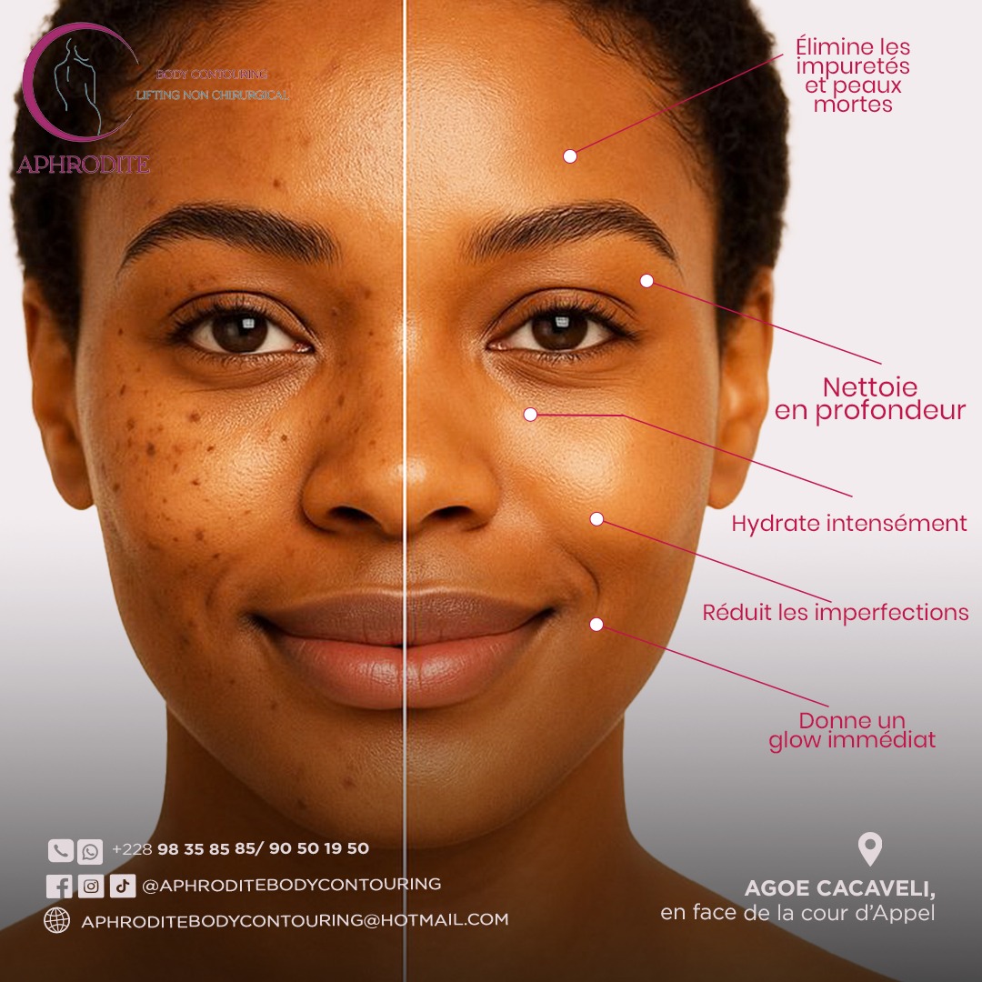 Avant/après Hydrafacial