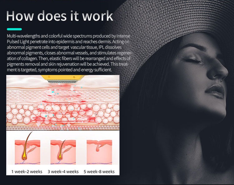 Soins IPL Laser — photo 5