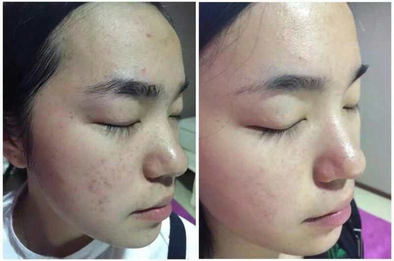 Soins IPL Laser — photo 9